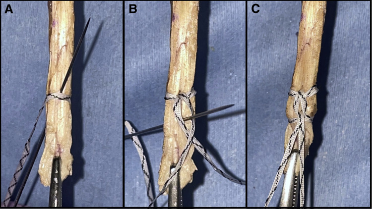 ArthroscopyJ's tweet image. 🦵 How do you prepare your hamstring grafts? This biomechanical analysis in ASMAR shows hamstring graft prepared with SutureTape may be an appropriate option for ACLR.    #hamstringACL #graftpreparation #kneesurgery 

ow.ly/OdYb50F3Oy1