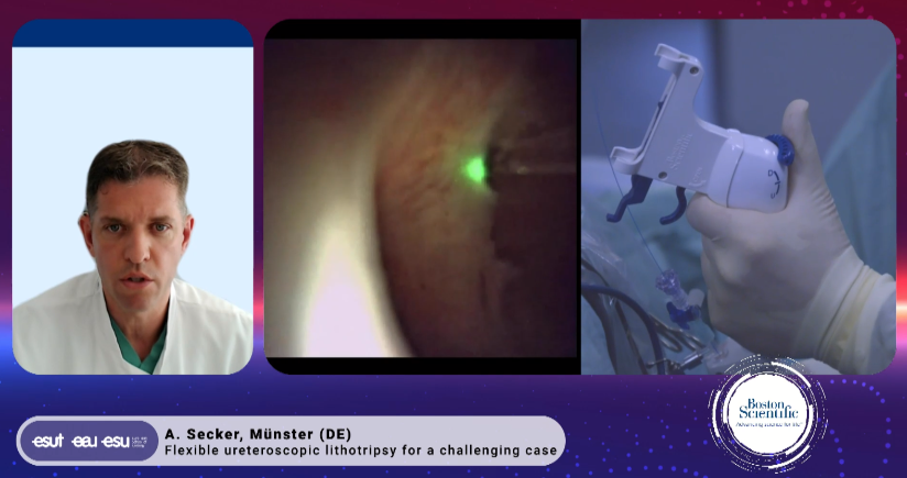 bsc_urology's tweet photo. During #esurolithiasis21 Masterclass: @SeckerArmin discusses challenging flexible treatment of stones in horseshoe kidney w/ Lithovue Empower and TRIA stent. #stonesmart.

More on LithoVue Empower: https://t.co/vR4GFmVzvC
And on Tria stent: https://t.co/w1XgDTI5UP https://t.co/jz3nErRrSE