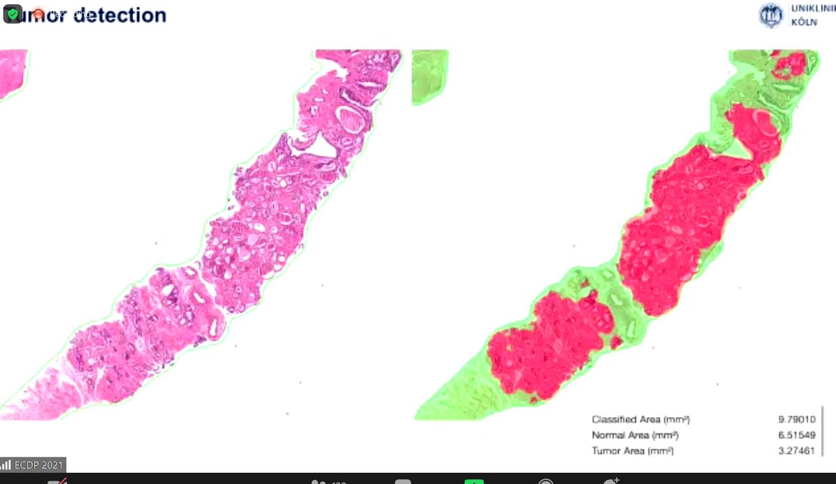 sabine_leh's tweet image. Insightful discussion in the oral free presentation session: &quot;Most pathologists working with AI trust AI more than they should - therefore agreement is actually a big problem! &quot;@y_tolkach  #ECDP2021 @ESDIPatho