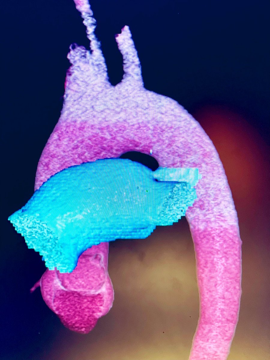 Ditongaje's tweet photo. PDA closure for type A with 8/6 ADO. Not commonly seen in adult but always good for the team to do it periodically. #patentductusarteriosus #pdaclosure #amplatzer #structuralheart #structuralheartintervention https://t.co/tSc242Miu7
