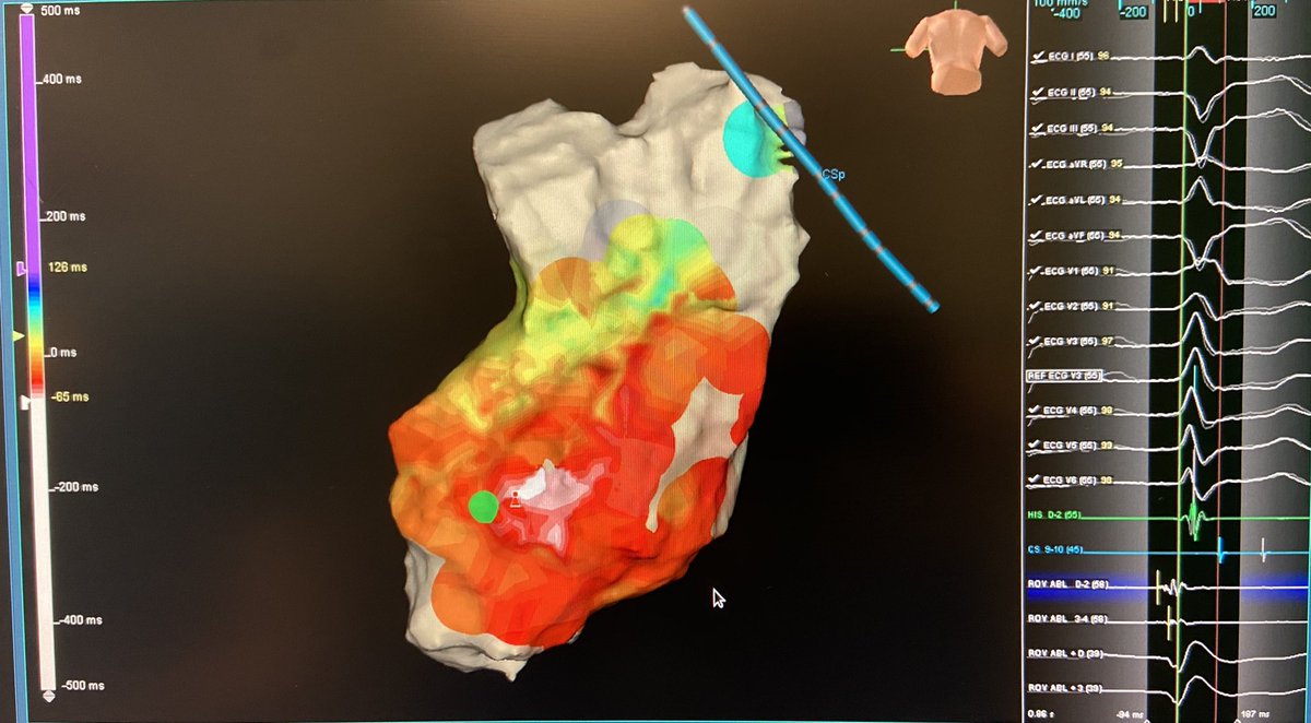 texasEPkait's tweet photo. A moving 🎯 of PVCs today. After locating and ablating these 4 morphologies, the patient left the lab with none! Ablated by @PraveenRao_EP using #hdgrid from @AbbottCardio #ablatevt #EPeeps https://t.co/oOKb0UZrHr