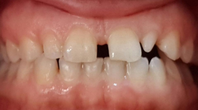 Diastema and Microdontia