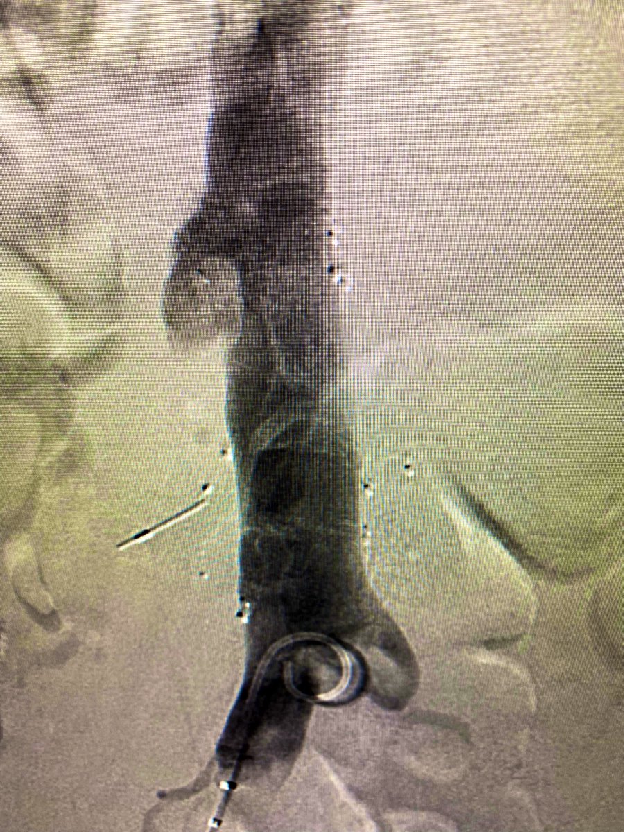 SGueyikian's tweet photo. Are we still doing #filterout Fridays? Let me drop the mic with this. BIRD’S nest w 21 yr dwell time. One leg in aorta. One leg completely outside ivc. Placed as a teenager after trauma, now normal. All metal is now out, radio-opaque flecks left behind.
@kmadass @SDhandMD #irad https://t.co/jhwQ6Sa7ic