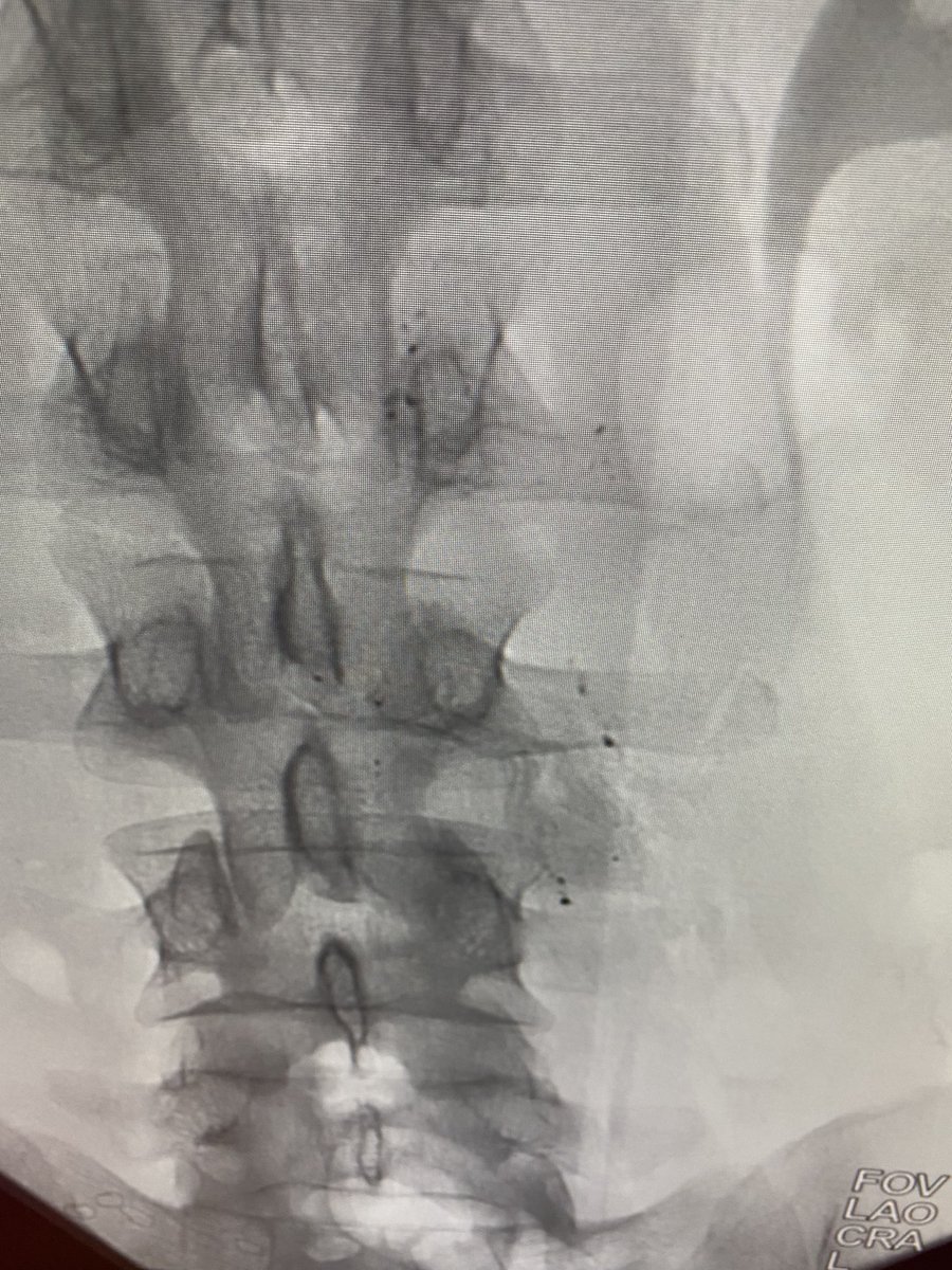SGueyikian's tweet photo. Are we still doing #filterout Fridays? Let me drop the mic with this. BIRD’S nest w 21 yr dwell time. One leg in aorta. One leg completely outside ivc. Placed as a teenager after trauma, now normal. All metal is now out, radio-opaque flecks left behind.
@kmadass @SDhandMD #irad https://t.co/jhwQ6Sa7ic