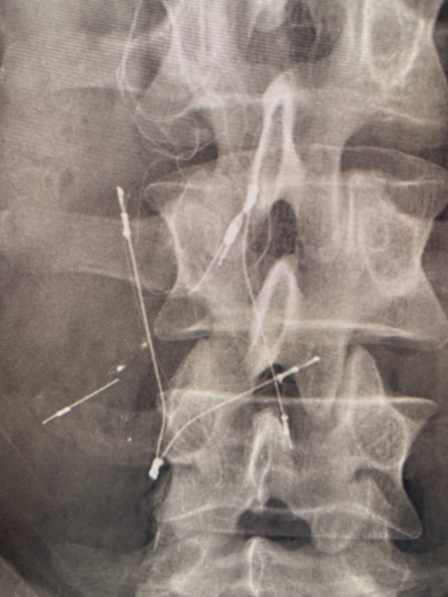 SGueyikian's tweet photo. Are we still doing #filterout Fridays? Let me drop the mic with this. BIRD’S nest w 21 yr dwell time. One leg in aorta. One leg completely outside ivc. Placed as a teenager after trauma, now normal. All metal is now out, radio-opaque flecks left behind.
@kmadass @SDhandMD #irad https://t.co/jhwQ6Sa7ic