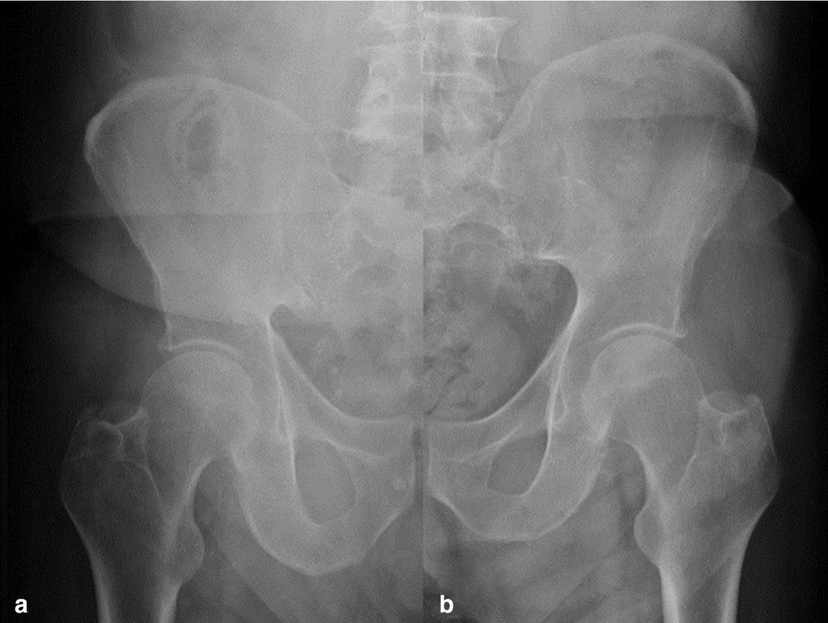 Prof Bev Snaith (@myradres) on Twitter photo Really pleased to see this paper published. Shows the implications of postural change on X-ray dose and image quality and reinforces the radiographers role in image optimisation. Great to work with Kholoud, Kevin, <a href="/aengland1/">Andrew England</a> and <a href="/p_peterhogg/">peter hogg</a> Really pleased to see this paper published. Shows the implications of postural change on X-ray dose and image quality and reinforces the radiographers role in image optimisation. Great to work with Kholoud, Kevin, <a href="/aengland1/">Andrew England</a> and <a href="/p_peterhogg/">peter hogg</a>