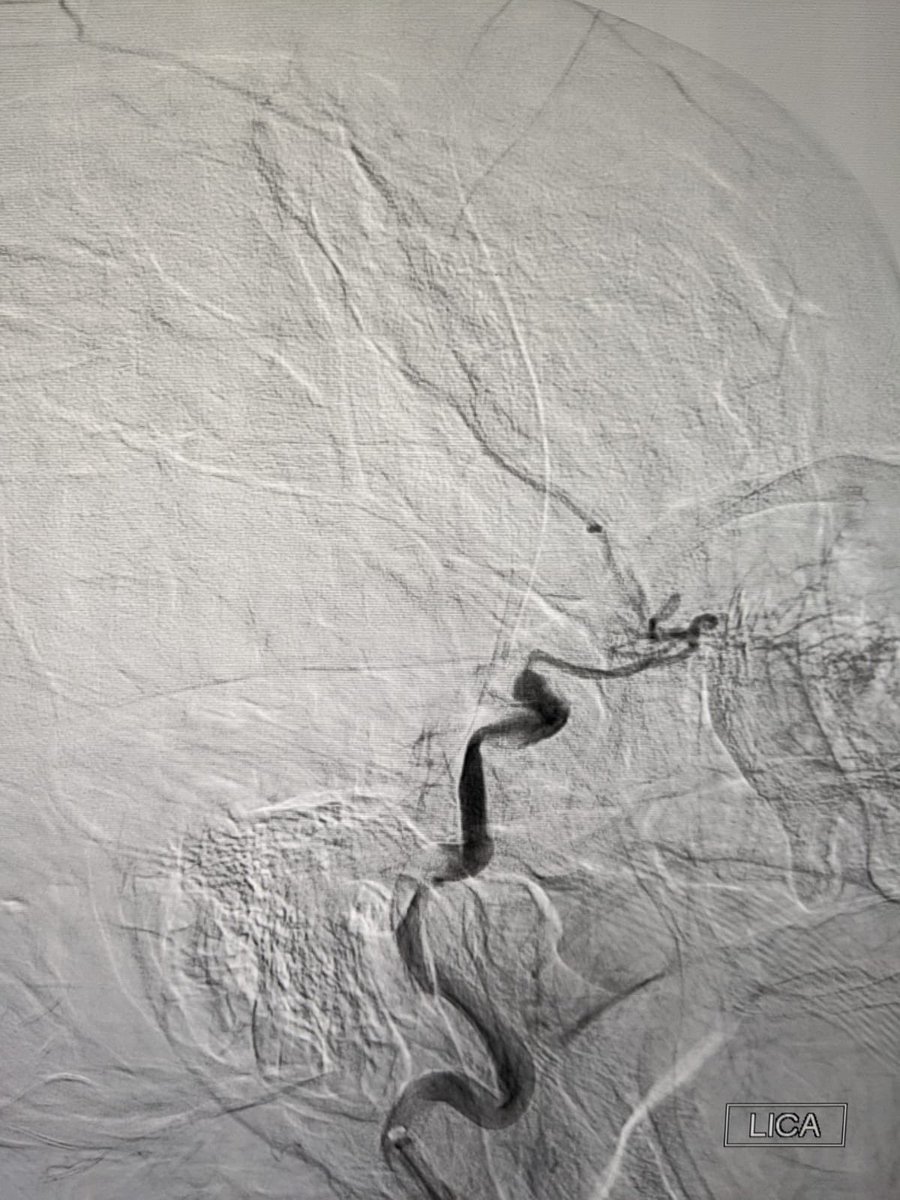 Barts Health Interventional Neuroradiology tweet media