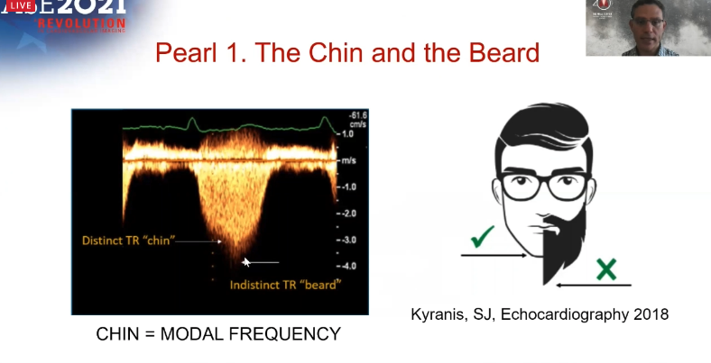 Akhil Narang, MD (@akhilnarangmd) on Twitter photo Estimating PASP from #EchoFirst TR jet? Measure the chin (modal velocity) and not the beard. Superb talk by Francois Haddad full of pearls for imaging pulmonary hypertension. #ASE2021. <a href="/ASE360/">American Society of Echocardiography</a> Estimating PASP from #EchoFirst TR jet? Measure the chin (modal velocity) and not the beard. Superb talk by Francois Haddad full of pearls for imaging pulmonary hypertension. #ASE2021. <a href="/ASE360/">American Society of Echocardiography</a>
