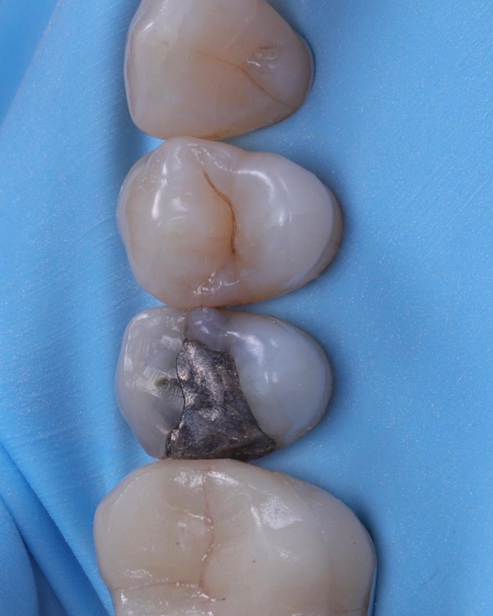 BurnestonDental's tweet image. Daily workflow… replacement of a defective silver filling. Improving the aesthetics as well as the biomimetics of the filling and tooth. #dentist #smile #directcomposite #rubberdam #biomimetic #biomimeticdentistry #aestheticdentistry #confidence #guildford #improveeveryday