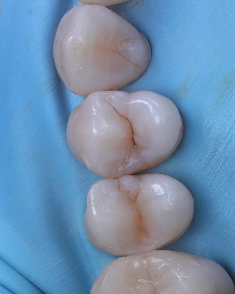 BurnestonDental's tweet image. Daily workflow… replacement of a defective silver filling. Improving the aesthetics as well as the biomimetics of the filling and tooth. #dentist #smile #directcomposite #rubberdam #biomimetic #biomimeticdentistry #aestheticdentistry #confidence #guildford #improveeveryday