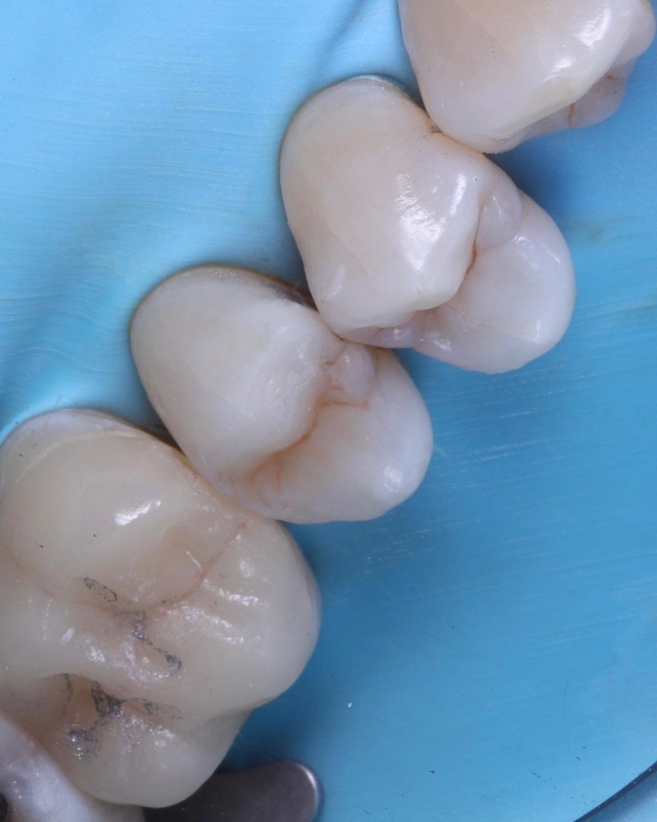 BurnestonDental's tweet image. Daily workflow… replacement of a defective silver filling. Improving the aesthetics as well as the biomimetics of the filling and tooth. #dentist #smile #directcomposite #rubberdam #biomimetic #biomimeticdentistry #aestheticdentistry #confidence #guildford #improveeveryday