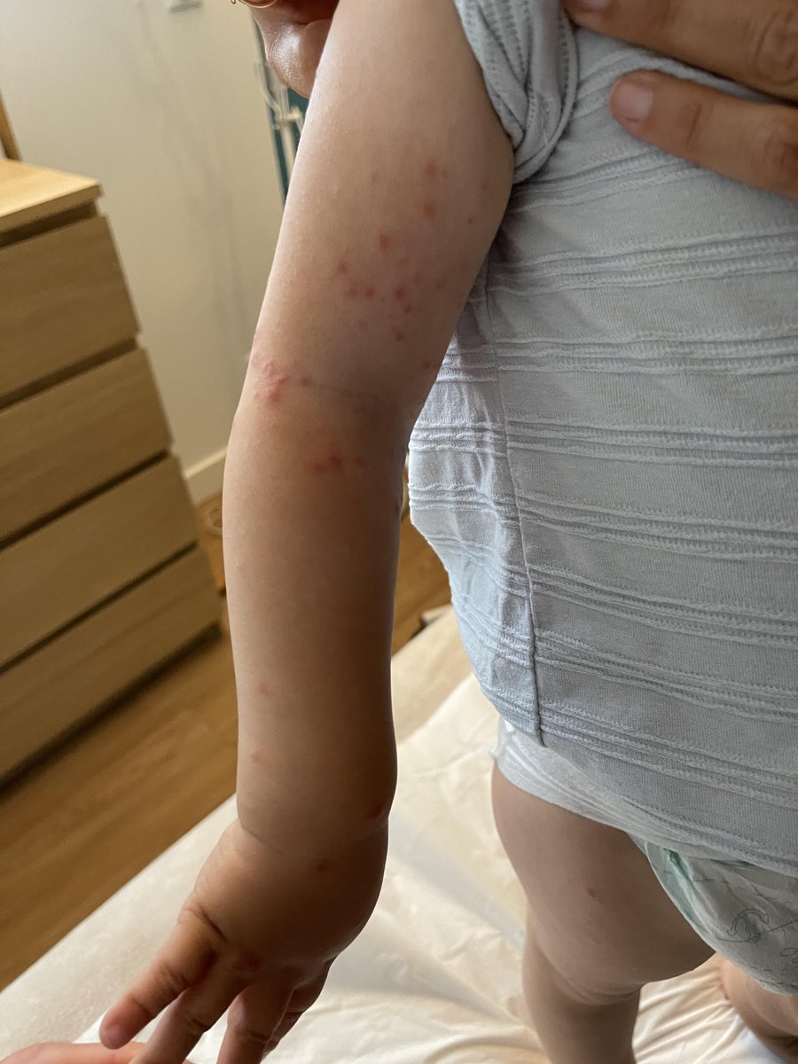 #Doctoctoc H21mois, éruption depuis 3 jours se majorant, au niveau des 4 membres, surtout plis de flexion et un peu paume/plante, et sous la bouche. Eruption vesiculopapuleuse ss atteinte muqueuse. Pas de prurit, ATCD varicelle. Pas de fièvre, bon EG. Sd Pied/mains/bouche ?
