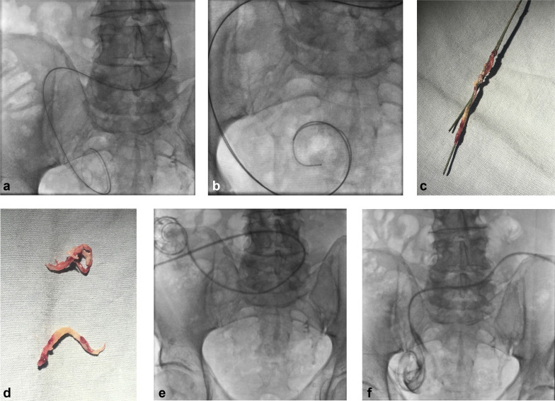 JVIR (@jvirmedia) on Twitter photo Salvage of Malfunctioning Peritoneal Dialysis Catheters: An Algorithm for Recanalization and Repositioning | ow.ly/m39t50EZ1kQ <a href="/rahim_samji1/">Rahim Samji</a> #irad Salvage of Malfunctioning Peritoneal Dialysis Catheters: An Algorithm for Recanalization and Repositioning | ow.ly/m39t50EZ1kQ <a href="/rahim_samji1/">Rahim Samji</a> #irad