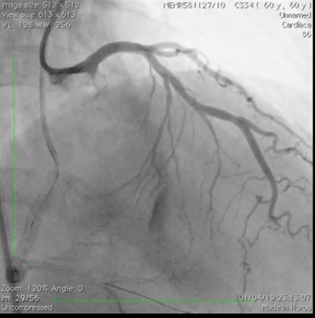 ForoEpic (@foroepic) on Twitter photo New case at foroepic.org from 🇲🇽Dissecting Hematoma as a complication of septal collateral chanel perforation in CTO-PCI of RCA by <a href="/mornei2011/">Neisser M</a> and moderated by <a href="/pbaglioni/">Pablo J. Baglioni 🇦🇷</a> 🇦🇷 <a href="/ResiSec/">ResiSEC</a> <a href="/JovenesSec/">JóvenesSEC</a> <a href="/foroic/">ArmandoPérez dePrado</a> <a href="/alfonso_freites/">Alfonso Freites</a> @AJuradoRoman <a href="/FelixValencia10/">Felix Valencia</a> <a href="/Felipediezhoyo/">Felipe Díez del Hoyo</a> New case at foroepic.org from 🇲🇽Dissecting Hematoma as a complication of septal collateral chanel perforation in CTO-PCI of RCA by <a href="/mornei2011/">Neisser M</a> and moderated by <a href="/pbaglioni/">Pablo J. Baglioni 🇦🇷</a> 🇦🇷 <a href="/ResiSec/">ResiSEC</a> <a href="/JovenesSec/">JóvenesSEC</a> <a href="/foroic/">ArmandoPérez dePrado</a> <a href="/alfonso_freites/">Alfonso Freites</a> @AJuradoRoman <a href="/FelixValencia10/">Felix Valencia</a> <a href="/Felipediezhoyo/">Felipe Díez del Hoyo</a>