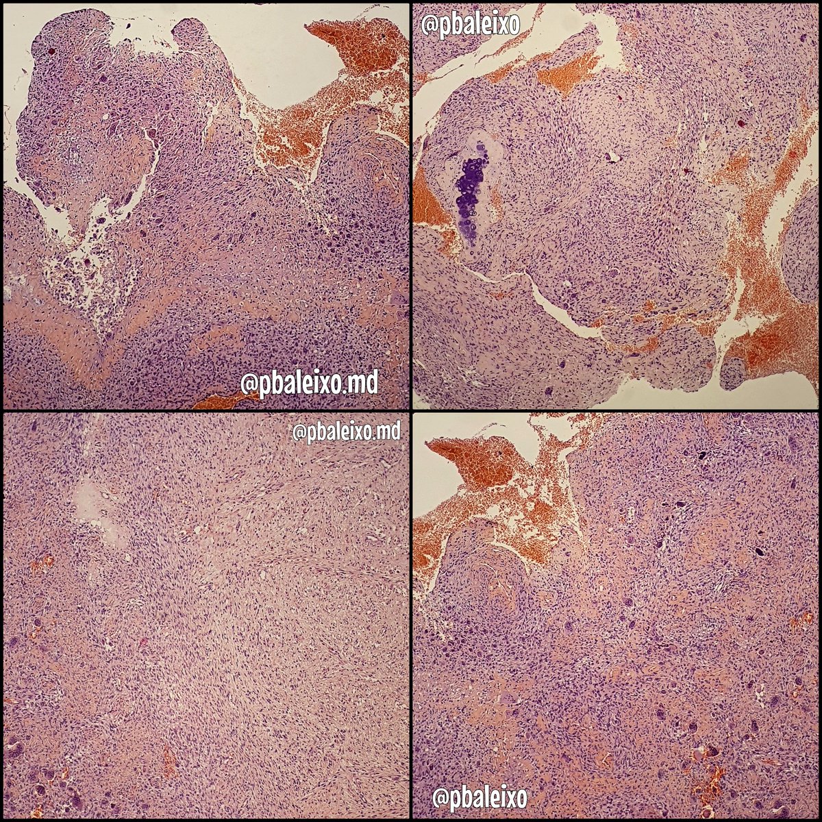 pbaleixo's tweet photo. 56yom》distal humerus large lytic tumor》mix of bland spindle fibroblastic cells, osteoclast-type giant cells &amp; reactive woven+blue bone》no atypical mitosis》more solid than cystic areas》aneurysmal bone cyst #BSTPath @UFCSPA_patho @ScottBikeethan @histiocytosisX @JMGardnerMD https://t.co/UeEdlPhiJe