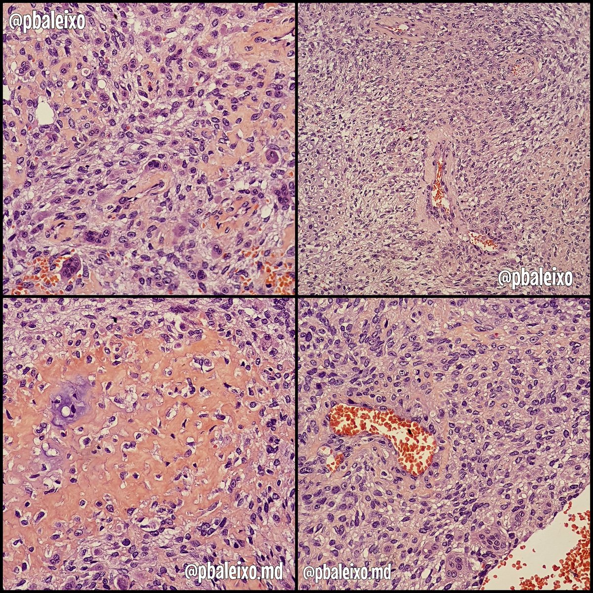 pbaleixo's tweet photo. 56yom》distal humerus large lytic tumor》mix of bland spindle fibroblastic cells, osteoclast-type giant cells &amp; reactive woven+blue bone》no atypical mitosis》more solid than cystic areas》aneurysmal bone cyst #BSTPath @UFCSPA_patho @ScottBikeethan @histiocytosisX @JMGardnerMD https://t.co/UeEdlPhiJe
