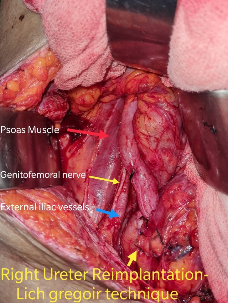 42 year female underwent open  hysterectomy for fibroid uterus, diagnosed with right uretero vaginal fistula. 
Right Extravesical ureteric reimplantation done using lich gregoir technique.
<a href="/so_uro/">UroSoMe</a> 
<a href="/Uroweb/">European Association of Urology (EAU)</a>
<a href="/YouthUSI/">YOUsi</a>
<a href="/UroResidency/">UroResidency</a>
<a href="/jj_urology/">JJ School of Reconstructive Urology</a>
#lichgregoir
#ureteroveginalfistula