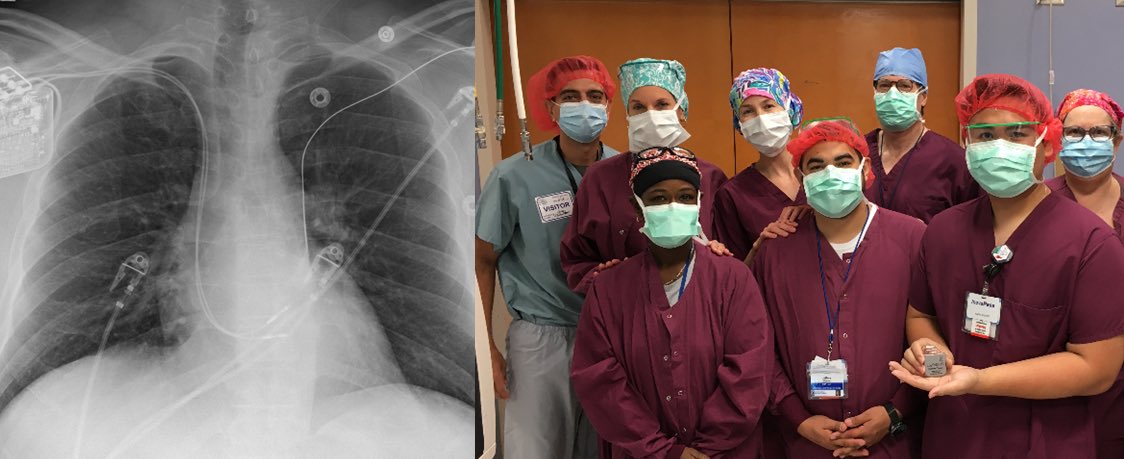 Congratulations to Marc Wish and the entire @IHVInews EP team on the first <a href="/ModulateHF/">Impulse Dynamics</a> Optimizer CCM implant in Northern VA!  Very proud to offer this important therapy to patients with advanced HF. #EPeeps <a href="/coconnormd/">Christopher O'Connor</a> <a href="/ShashankSinhaMD/">Shashank Sinha, MD, MSc, FACC, FAHA, FHFSA</a> <a href="/mpsotka/">Mitchell Psotka</a>