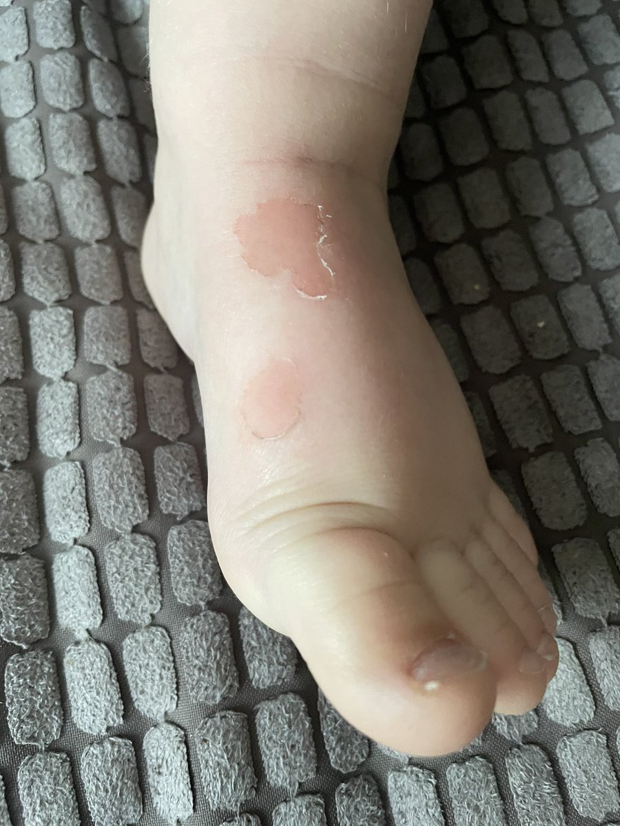 L_Payney's tweet photo. @clarksshoes I thought your shoes were supposed to be well fitted. So why has my son never had an issue with shoes and the first pair of yours that he’s had properly measured and fitted have done this to his feet? They are so sore, poor little man 😢 https://t.co/tsrjpqUmcB
