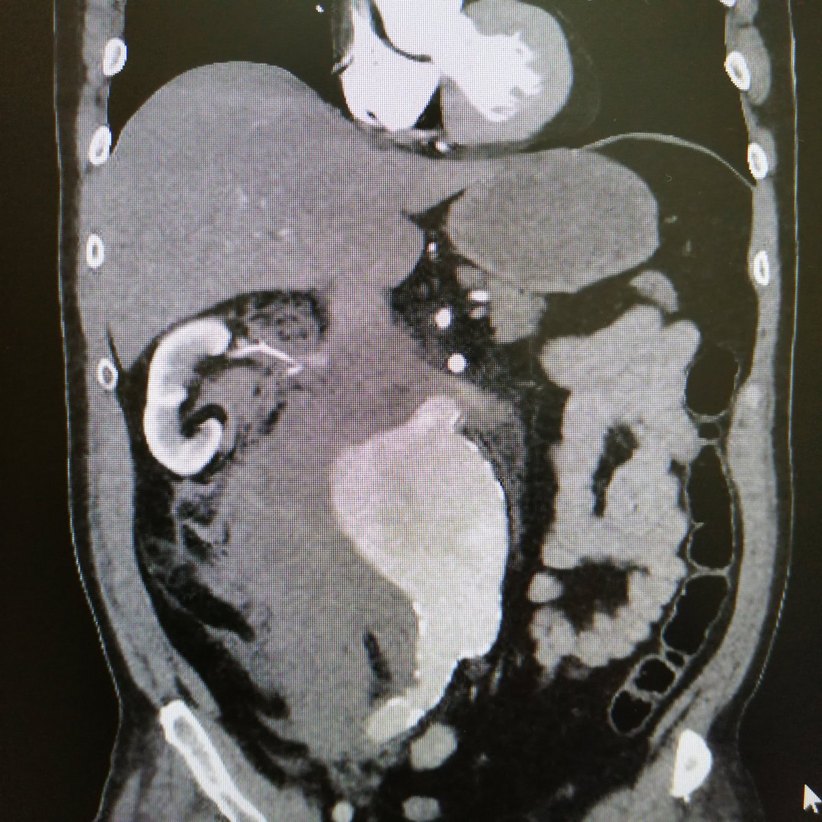 Happy Father's Day! 

Remember to remind dads everywhere to attend for their free NHS Abdominal Aortic Aneurysm (AAA) screening appointment.

This is potentially a life saver.

nhs.uk/conditions/abd…