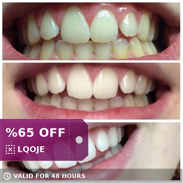 whitewithstyle's tweet photo. Daily Savings! 😍 Sparkle White Teeth Whitening Kit w/Coconut Activated Charcoal 😍 
by Whitewithstyle starting at $146.99. 
Shop now 👉👉 https://t.co/9BQJlFK1uk https://t.co/pOR4qBEyja