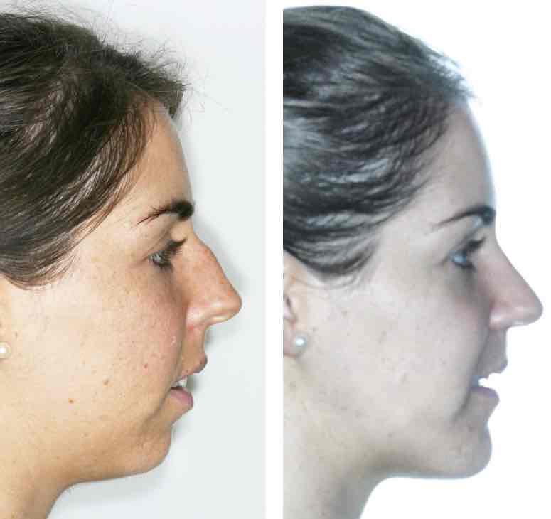⚡️ Cirugía ortognática + rinoplastia + mentoplastia ⚡️

Nuestra prioridad es conseguir la excelencia en el tratamiento.

#maxilofacial #birbe #clinicabirbe #cirugiamaxilofacial #maxillofacial #orthognathicsurgery #jawsurgery #cirugiaortofacial#ortofacialsurgery