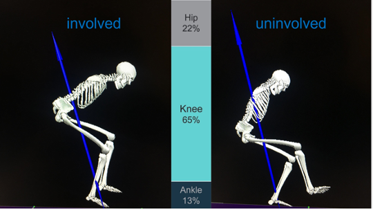 BJSM_BMJ's tweet photo. Does hop-distance determine your #ReturnToSport decision? You might want to read this blog if so for some extra context... #ACL

@RoulaKotsifaki 🙌

https://t.co/n69eXsFtFC https://t.co/GbqtnBBjRM