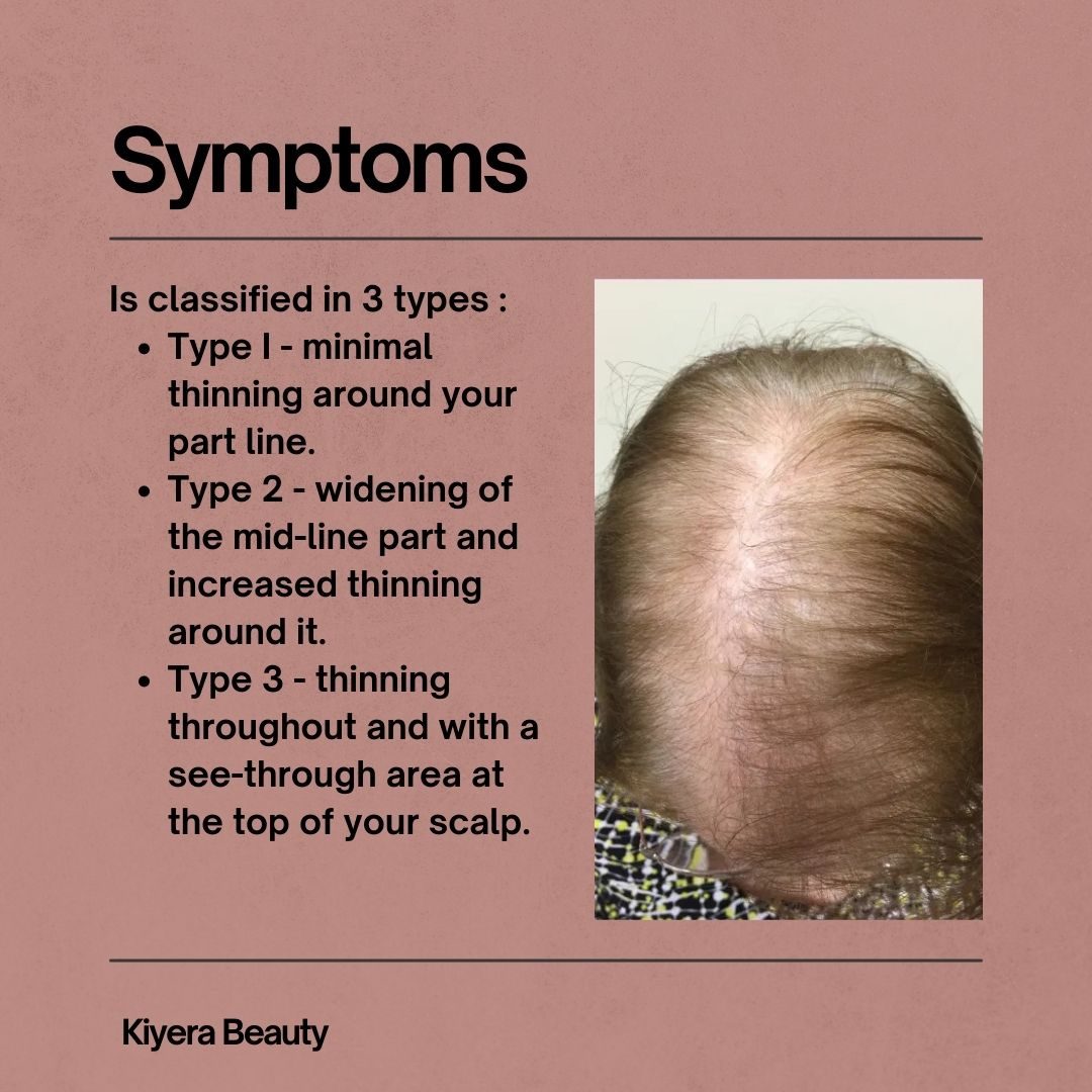 kiyerabeauty's tweet photo. Female pattern baldness (androgenic alopecia) is a type of #hairloss that affects women. Scroll through to learn more about its causes &amp; symptoms.
.
Share and Retweet!
.
.
#naturalhairtips #androgenicaalopecia #femalepatternbaldness #hairlossinwomen #haircare #hairtwitter https://t.co/pIri8Qtwnd