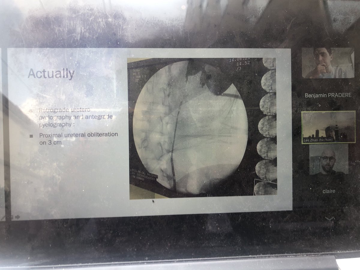 Benjamin Pradere (@benjaminpradere) on Twitter photo Amazing to see live cases discussions on robotic urinay reconstruction w/ <a href="/lee_c_zhao/">Lee Zhao</a> <a href="/NYUUrology/">NYU Langone Urology</a> and <a href="/BPeyronnet/">Benoît Peyronnet</a> <a href="/CHURennes/">CHU de Rennes</a> and team from <a href="/MedUni_Wien/">MedUni Wien</a>. Tele-mentoring for difficult cases is so powerful! Sharing knowledge for a better care have never been so easy. Patients first Amazing to see live cases discussions on robotic urinay reconstruction w/ <a href="/lee_c_zhao/">Lee Zhao</a> <a href="/NYUUrology/">NYU Langone Urology</a> and <a href="/BPeyronnet/">Benoît Peyronnet</a> <a href="/CHURennes/">CHU de Rennes</a> and team from <a href="/MedUni_Wien/">MedUni Wien</a>. Tele-mentoring for difficult cases is so powerful! Sharing knowledge for a better care have never been so easy. Patients first