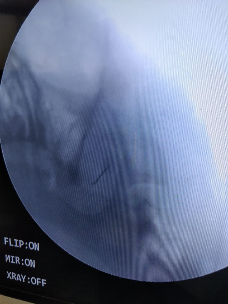 tariqtramboo's tweet image. Severe facial pain after Failed MVD (micro vascular decompression) surgery for #Trigeminalneuralgia. Did RFA for this patient today. Difficult case as CSF was everywhere due to distorted anatomy. Selective mandibular/maxillary division ablated near the foramen.  #Trigeminal