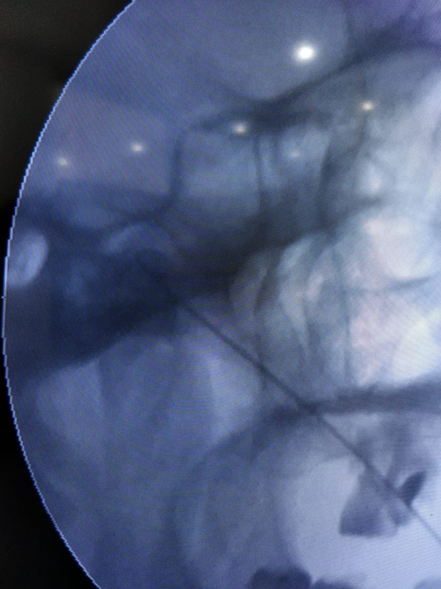 tariqtramboo's tweet image. Severe facial pain after Failed MVD (micro vascular decompression) surgery for #Trigeminalneuralgia. Did RFA for this patient today. Difficult case as CSF was everywhere due to distorted anatomy. Selective mandibular/maxillary division ablated near the foramen.  #Trigeminal
