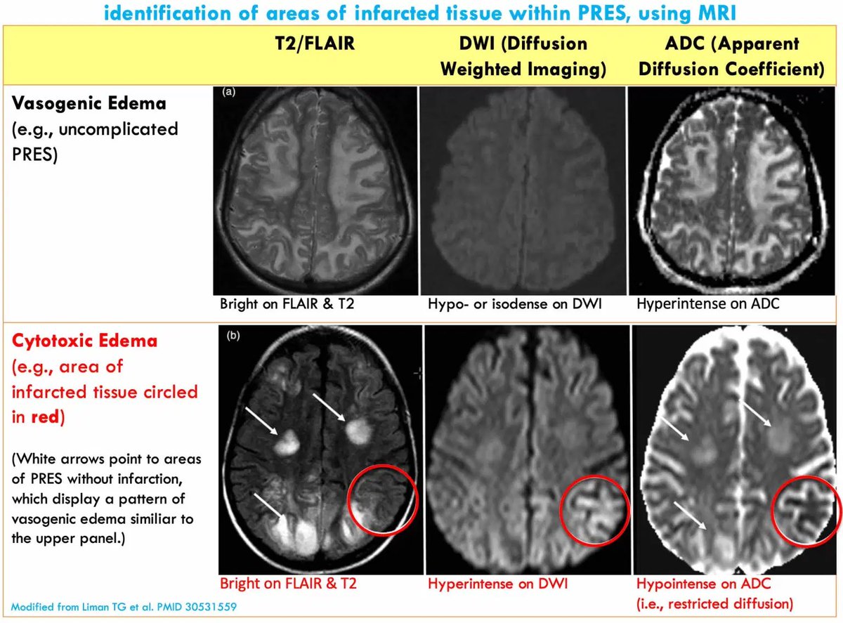 Posterior Reversible Encephalopathy Syndrome (PRES) 
🐡includes “hypertensive encephalopathy,” but ~20% of patients are *normotensive*
🐡may result from endothelial damage causing vasogenic edema
🐡seizure is common (can progress to status epilepticus)
emcrit.org/ibcc/pres/