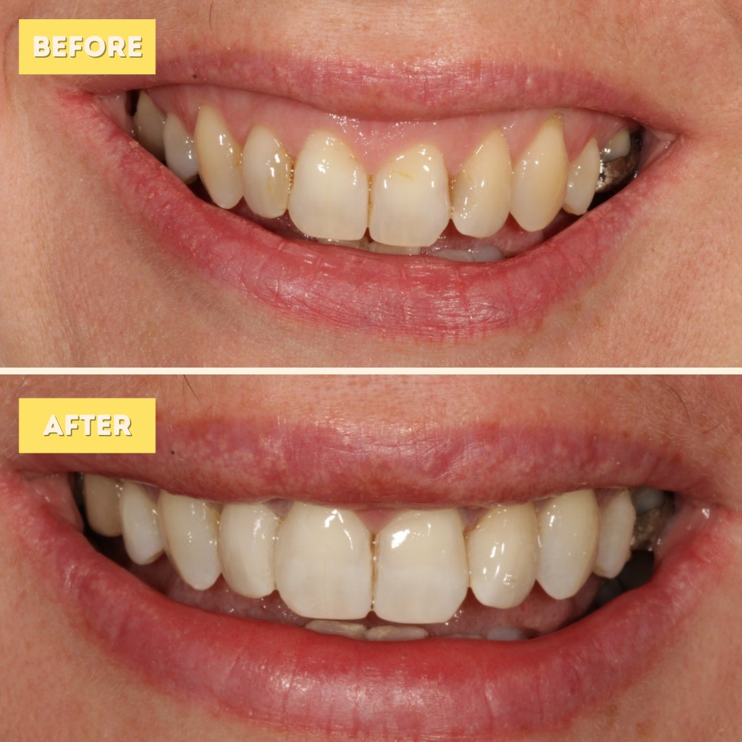 Composite Bonding is when a tooth-coloured resin is bonded to your teeth, then sculpted into the proper shape🤓

Find out which treatment is suitable for you by booking a Free Consultation!🤩

To book, click here: standrewsdentalcare.co.uk/request-a-free…

#compositebonding #standrews #fife