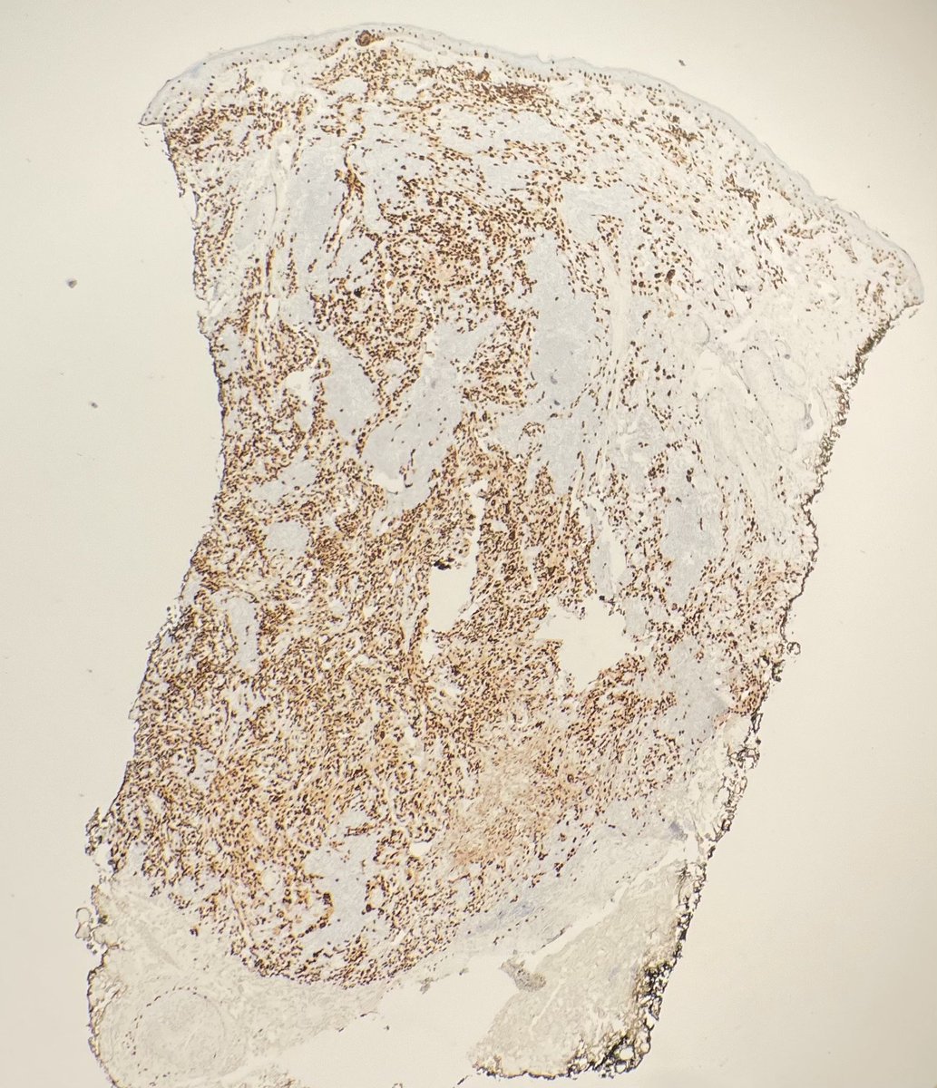 Lip papule, 75 YOF, indurated, ? SCC #dermpath #dermtwitter #Dermatology #PathTwitter #BSTPath