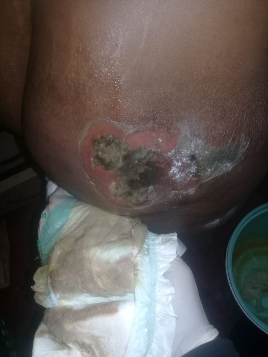 Anelisa44895602's tweet photo. I need your help to retweet till we get the answers we need as the family. Nompumelelo Makubalo went for a contraceptive injection at the Central Clinic in PE and due to their negligence she contracted a flesh eating infection which caused inability to walk, rotting and death. https://t.co/d88TlPaeeO
