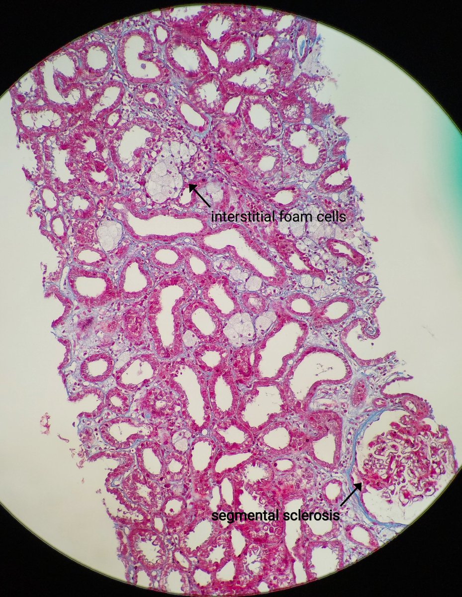 18y/F, abortion-22 weeks, 1.2g proteinuria, full field hematuria, S Cr: 0.5, ANA:Neg. These findings are clue to the diagnosis which can only be established by special IF and EM.
Thanks @DrSalah_nephro for the case. #renalpath #pathresident #nephrology #pathspotter #glomerulus