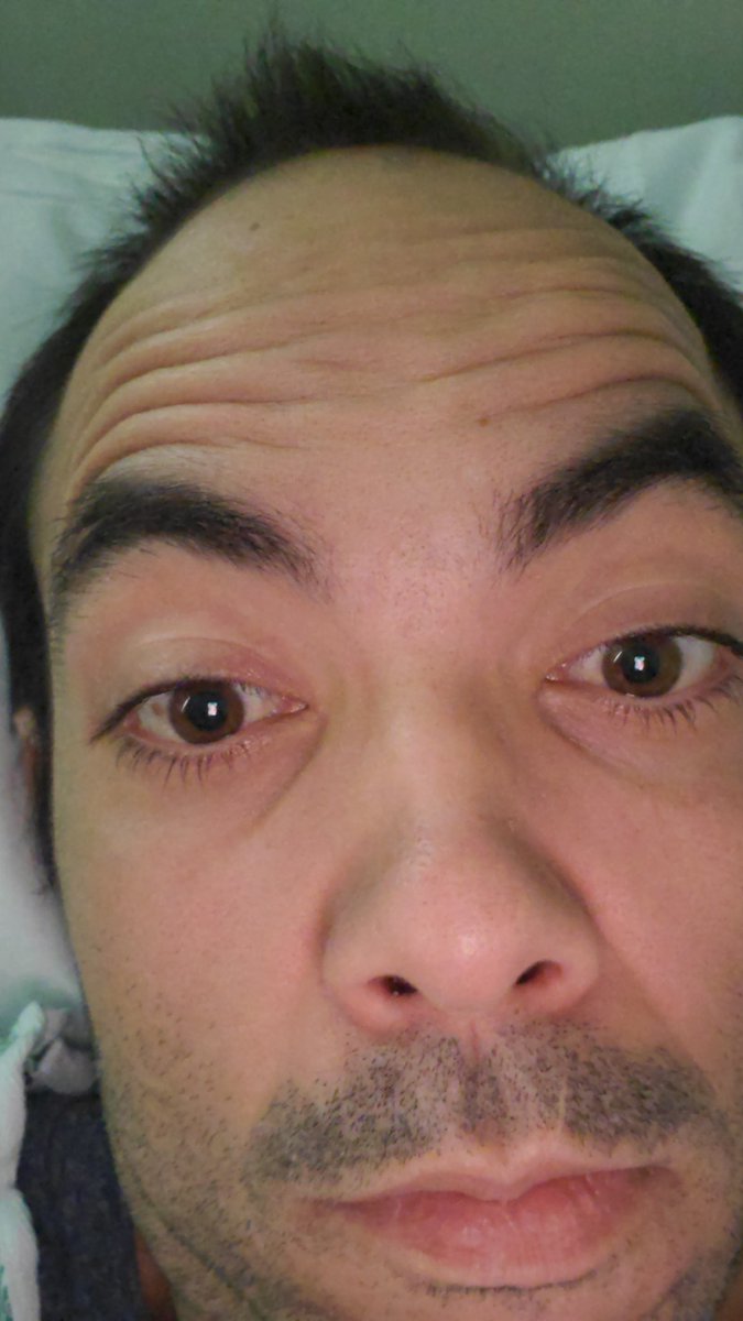 PTonypmartins's tweet photo. @POTUS President help me .i have weird case after a infection ..i been having double vision ..but doctor do a simple test and dont see any problem..But i see all double so i wish you can help me to find a study for my problem ..even  #Jacksonhealth  say they dont see nothing in mri?? https://t.co/gU8X2cDsci