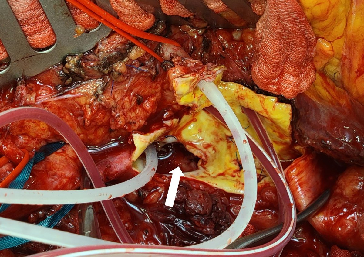Mycotic rupture of the paravisceral #aorta due to salmonella infection. Replacement with bovine #pericardium after radical excision of the affected aortic segment. Interestingly, a few weeks ago we had a rupture of the popliteal artery due to #Salmonella. 
#aortaed #aorticsurgery
