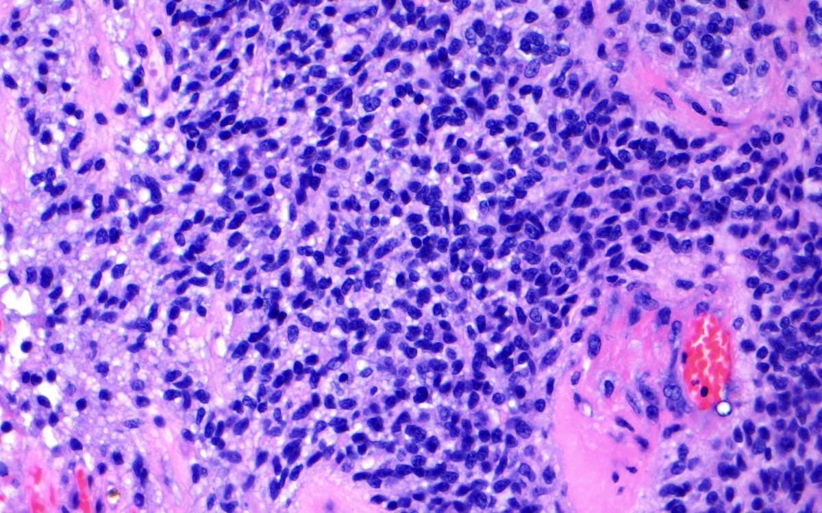 Small cell #glioblastoma, IDHwt with EGFR amplification and PTEN loss. DD anaplastic oligodendroglioma, lymphoma, 'PNET' and metastatic small cell carcinoma #pathology #neuropath #neurosurgery #molecularpathology #pathboards #PathTwitter #pathologist #braintumor  @NU_Pathology