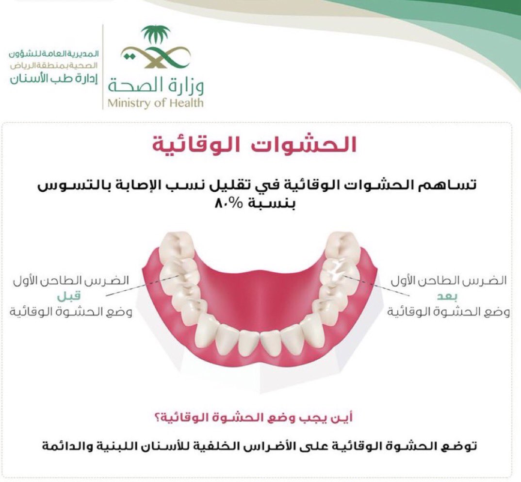 ماهي #الحشوات الوقائية ؟ 

#طب_الاسنان