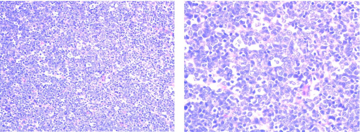 pillai_vinodh's tweet photo. CIC rearranged leukemia! Not every CIC is sarcoma and CD45 neg does not rule out leuk/lymph. Here is an erythroid leukemia with strong myeloid (CD43), erythroid markers Glycophorin C, GATA1, E-cadherin, CD71, GLUT1. Consider doing erythroid markers in these. @IHC_guy @JLHornick https://t.co/5jW87Z1xW1