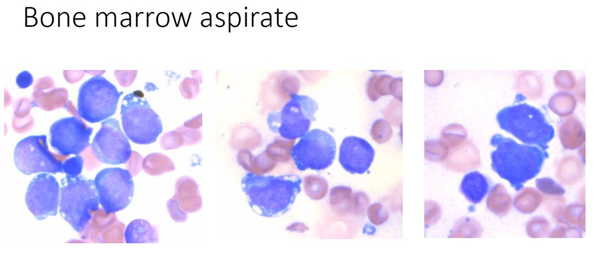 pillai_vinodh's tweet photo. CIC rearranged leukemia! Not every CIC is sarcoma and CD45 neg does not rule out leuk/lymph. Here is an erythroid leukemia with strong myeloid (CD43), erythroid markers Glycophorin C, GATA1, E-cadherin, CD71, GLUT1. Consider doing erythroid markers in these. @IHC_guy @JLHornick https://t.co/5jW87Z1xW1