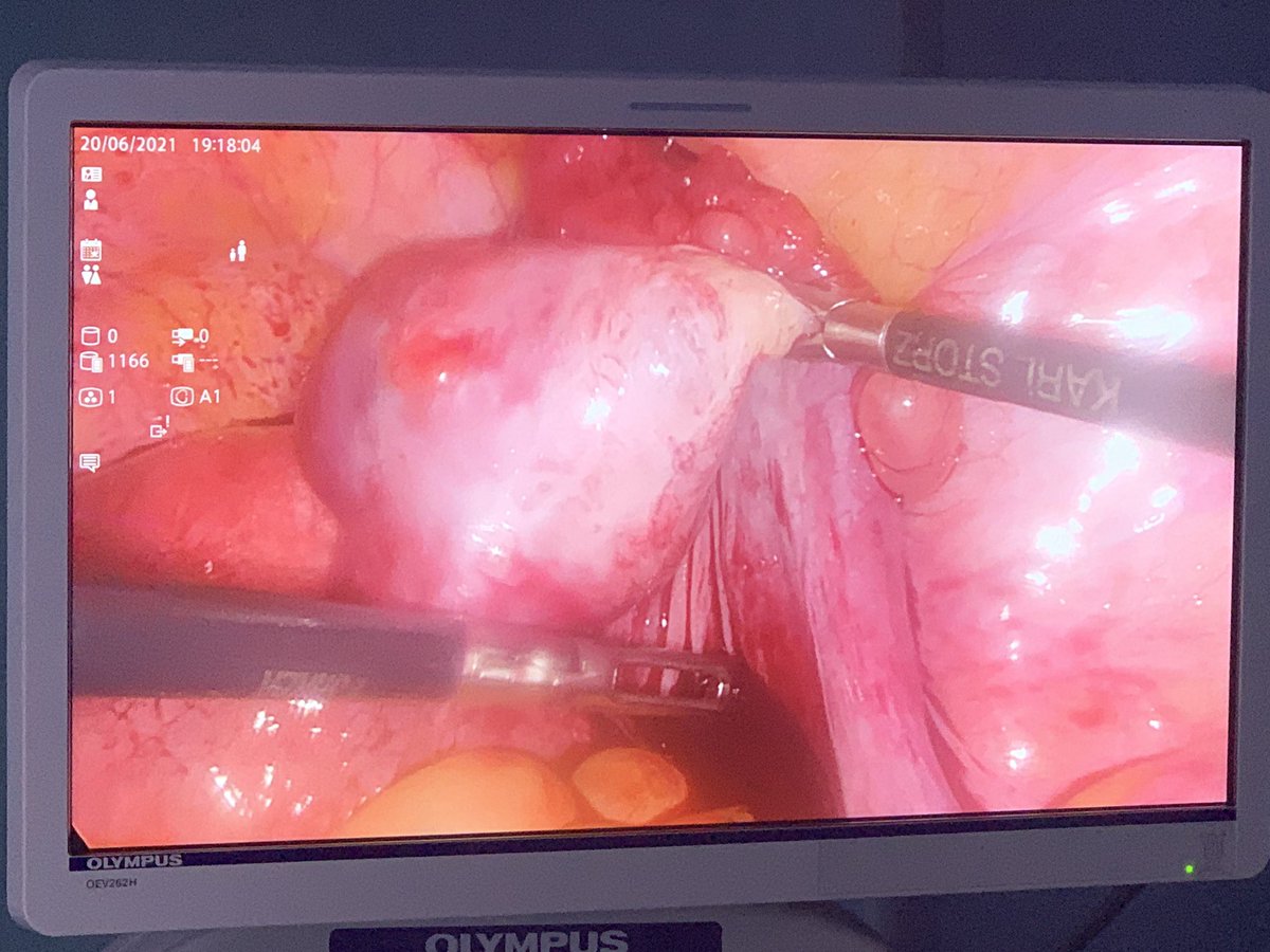 An ectopic pregnancy occurs when a fertilized egg grows outside of the uterus. more than 90% occur in a fallopian tube, it can cause the tube to burst (rupture). A rupture can cause major internal bleeding. This can be a life-threatening emergency that needs immediate surgery.