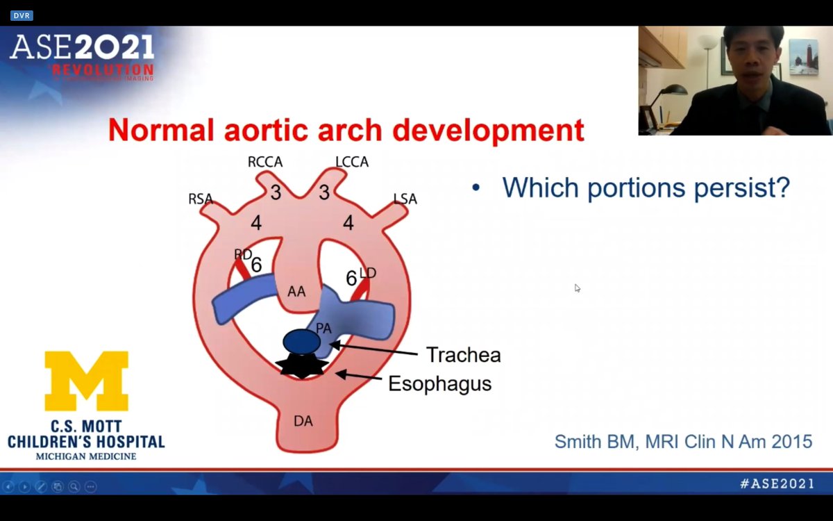 DrJenniferCo_Vu's tweet photo. #ASE2021 #PCHD track
🗣️Great talk on how to diagnose Vascular Rings by @Jimmy_C_Lu
🫀How to image aortic arch sidedness?
1⃣ Innominate artery bifurcation
2⃣ Transverse arch
3⃣ Tracheal rings
🫀Right arches can be normal - present in some #CHDs
@ASE360 #echofirst #VirtualEcho https://t.co/Be3J56zDPQ