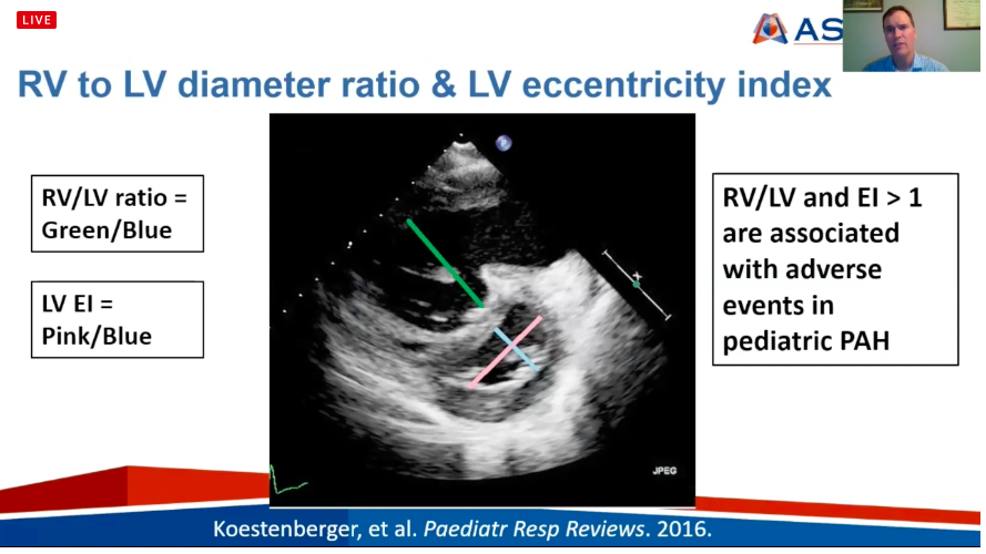 rsk86's tweet photo. Dr. Quartermain provides insight in assessment for PH #ASE2021 #EchoAtHome https://t.co/p4UZ7xh9F4