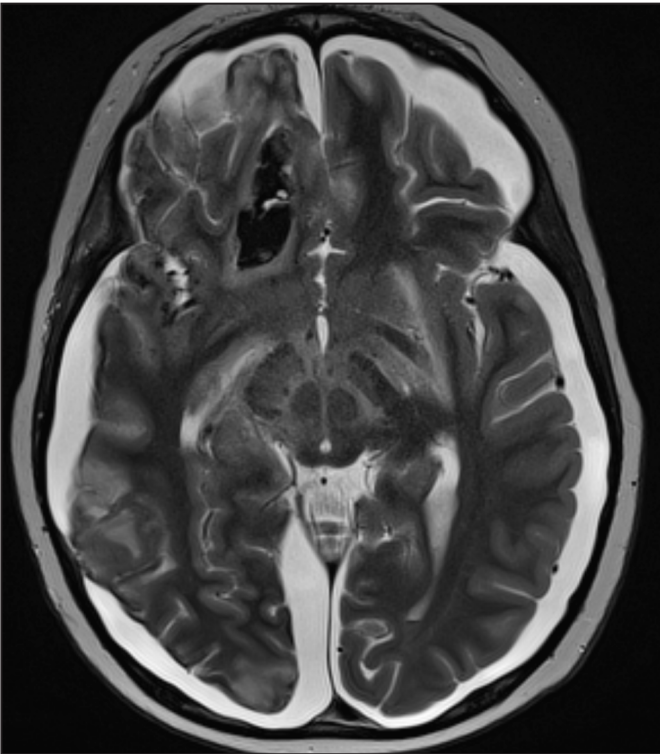 Applied_Rad's tweet photo. #App_Rad Pediatric Community | View a case study where acute infarcts and subdural hematomas were best visualized with #MRI with Degos Disease diagnosis that involves the #CNS.https://t.co/Jq39ZGkSrp #pediatrics #radiology #Guerbetgroup #NeuroRads #GBCA #PediatricRadiology https://t.co/vbwLKrq5ub