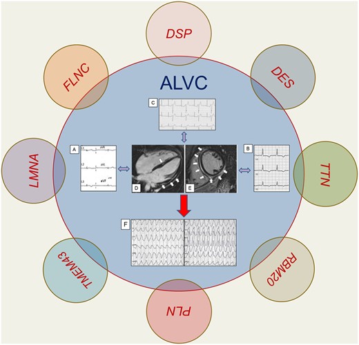 ehj_ed's tweet photo. Arrhythmic risk stratification in arrhythmogenic cardiomyopathy: new predictors for left-sided variants? Discover more from this Editorial in EHJ: https://t.co/k741NQ7igJ
#ALVC #cardiomyopathy #risk #cardiotwitter @escardio @ESC_Journals https://t.co/CJCOH8L5iR