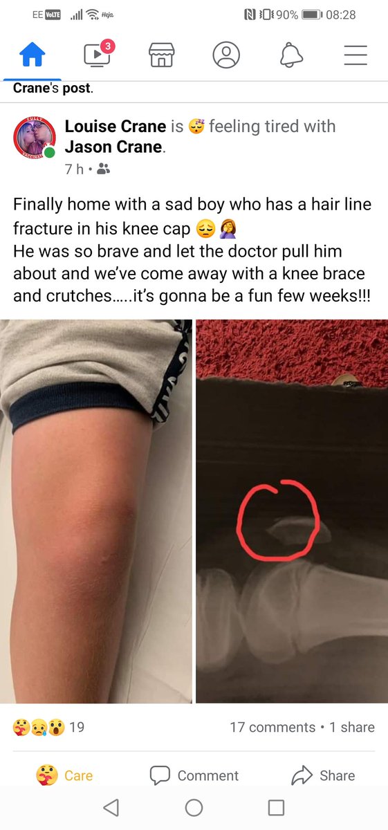 Long evening at A&amp;E to reveal a hairline fracture in his knee. He did it doing triple jump #fracture