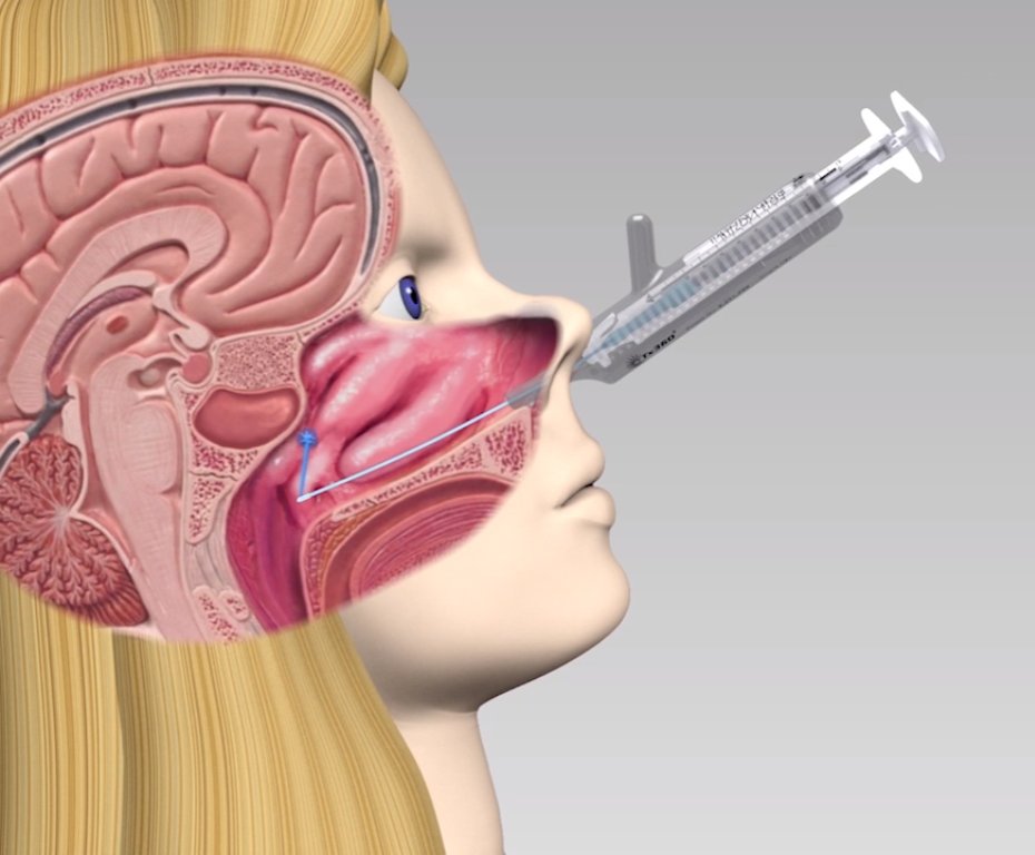 primneuromod's tweet photo. 🚩 Los bloqueos repetidos del ganglio esfenopalatino con el dispositivo #Tx360 son un tratamiento eficaz en la #cefalea en racimos crónica.

#migraña #dolor #dolorcrónico #dolorcronico https://t.co/PoQaopfCq3