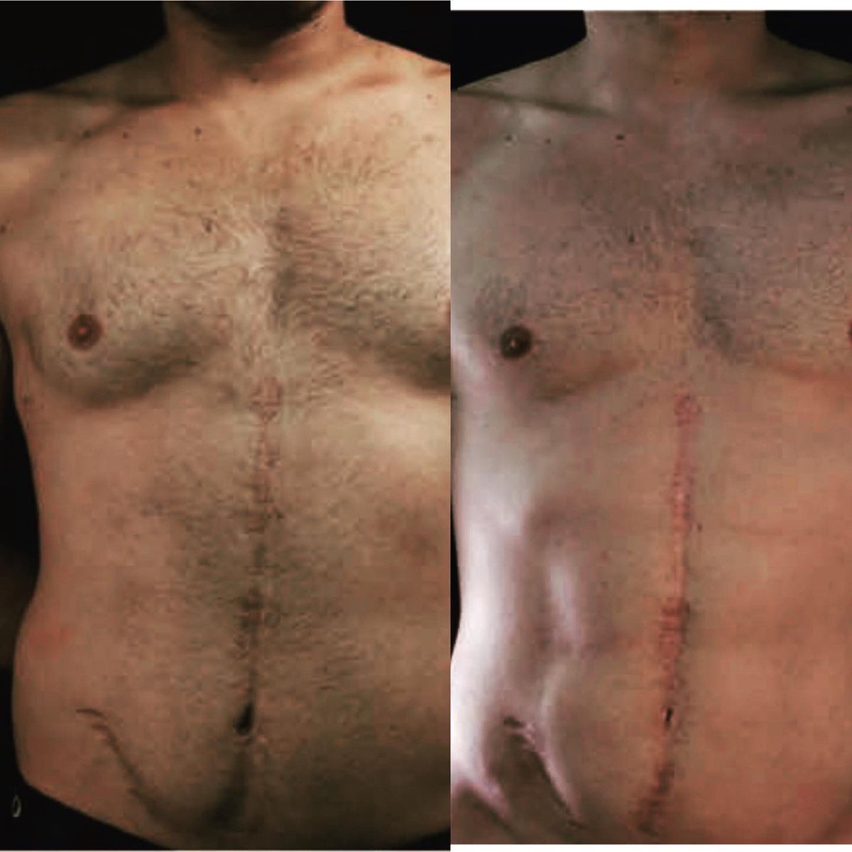 DrShivChopra's tweet photo. Find out how this transformation occurred for this #gynaecomastia  patient as well as 3 other great papers in Our #Plasticsurgery journal club. 23/6 1900 (SYD) zoom ID 857307486 Password Journal https://t.co/3ZcNrjVbQZ